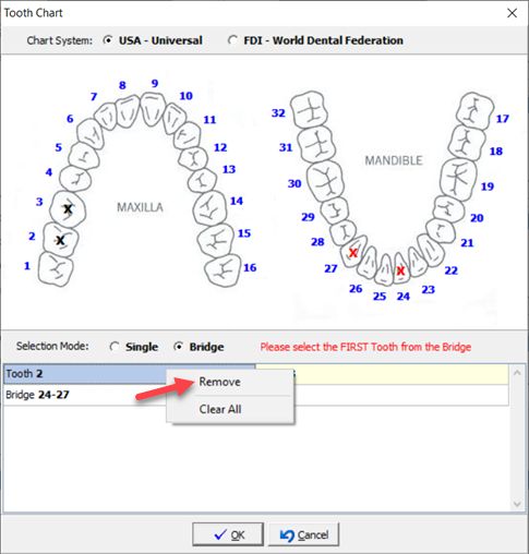 V12 - remove selected tooth